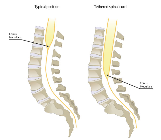 Spina Bifida Occulta Dimple