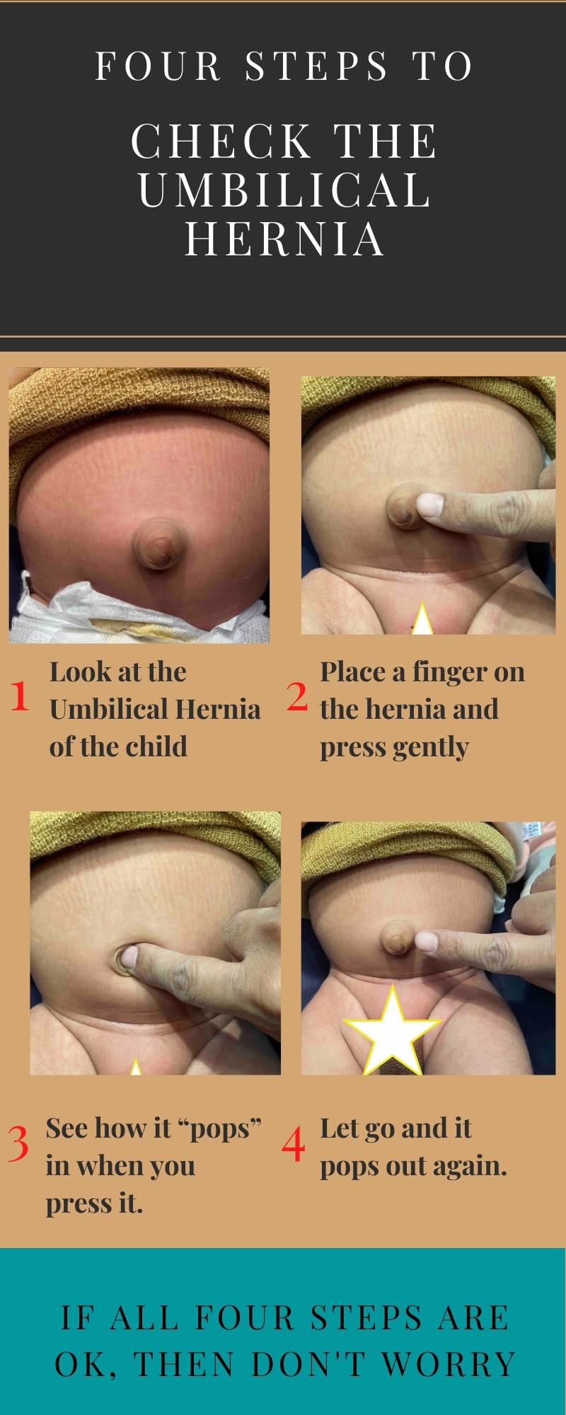 Umbilical Hernia In Babies: All That You Need To Know