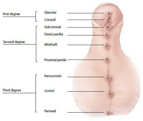 Types of Hypospadias