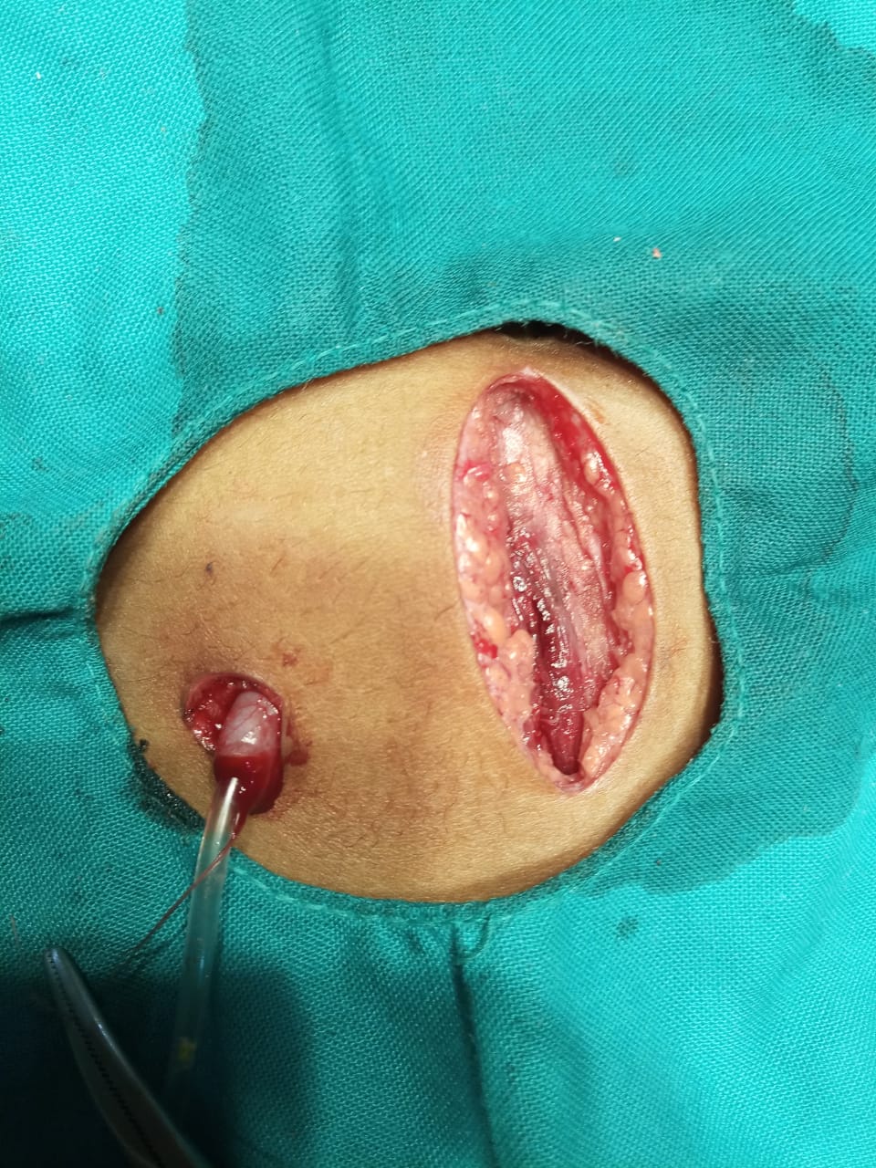 Appendicostomy (Malone Procedure)