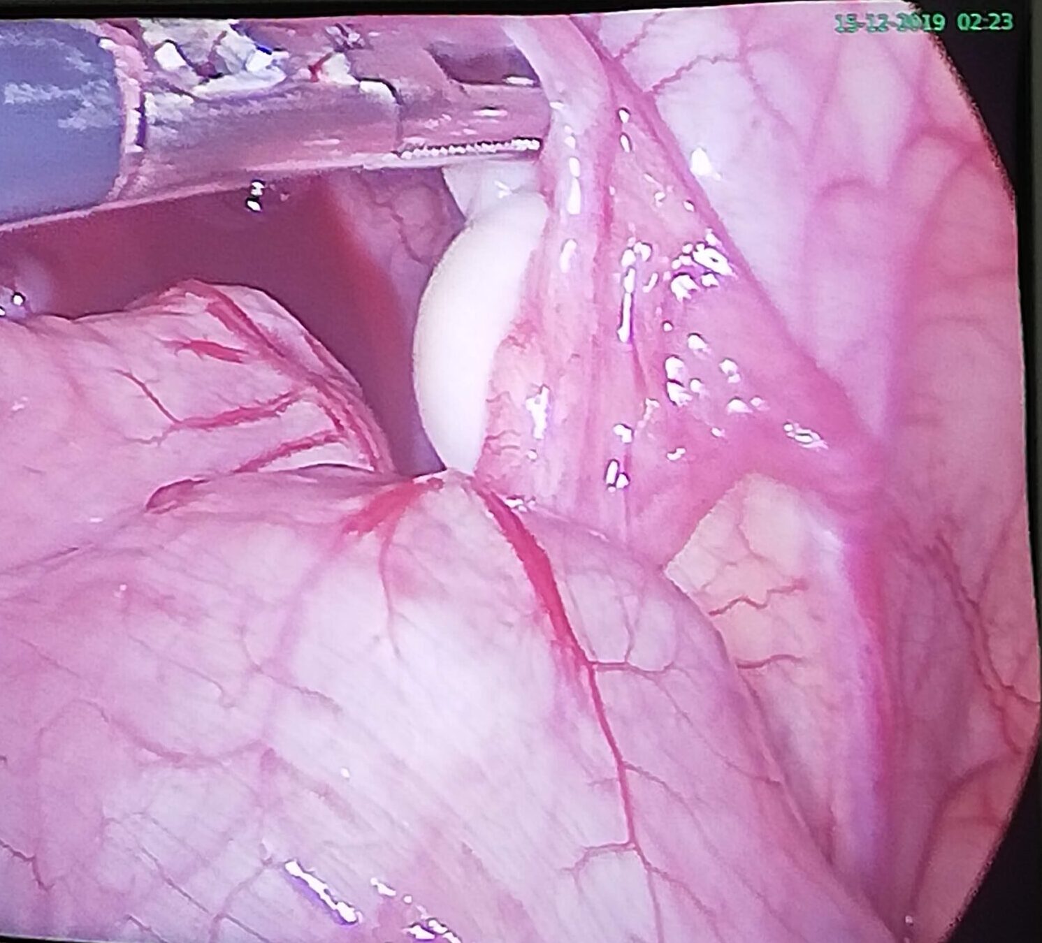 Lapraoscopic View of Child with undescended testis