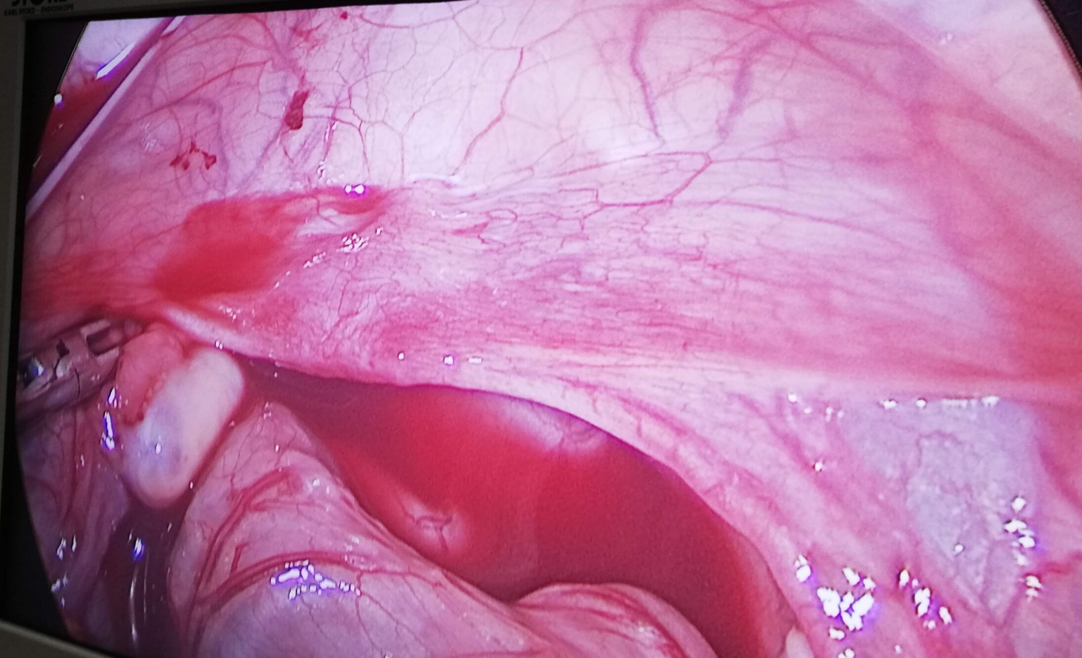 Lapraoscopic View of Child with undescended testis