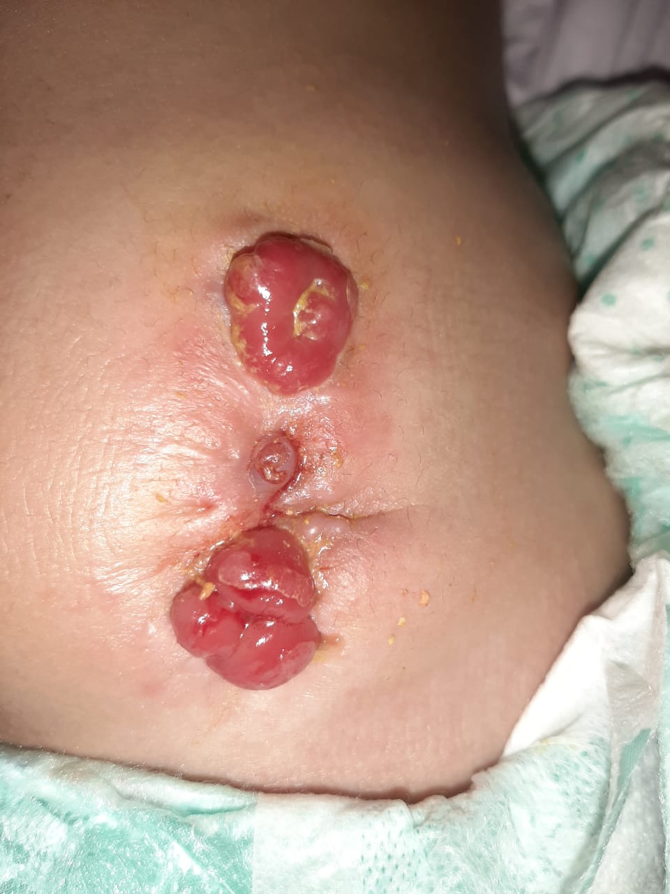 bleeding from colostomy stoma