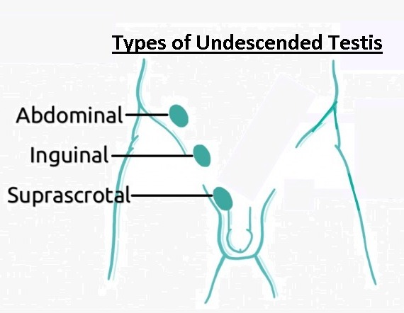 Types of Undescended Testis