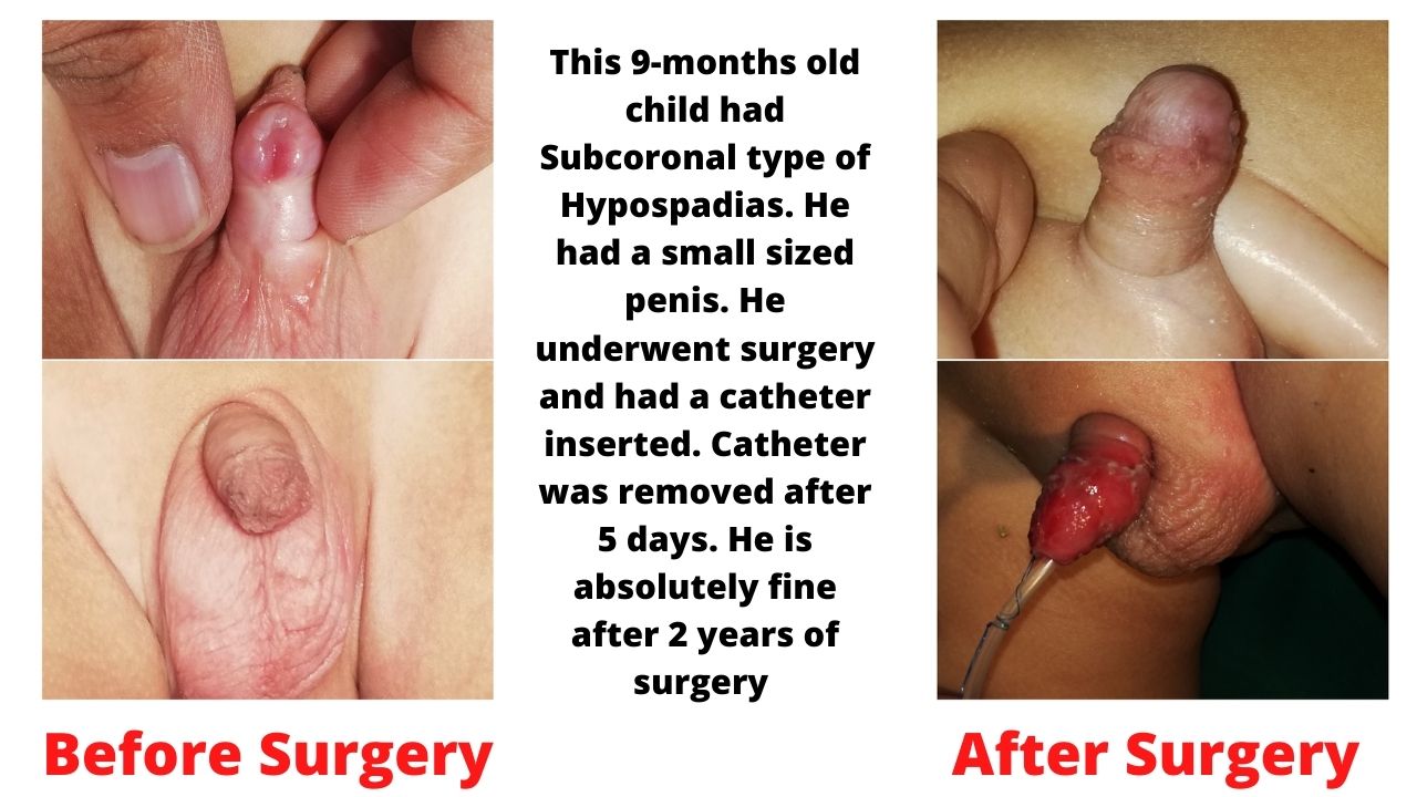 Subcoronal Hypospadias