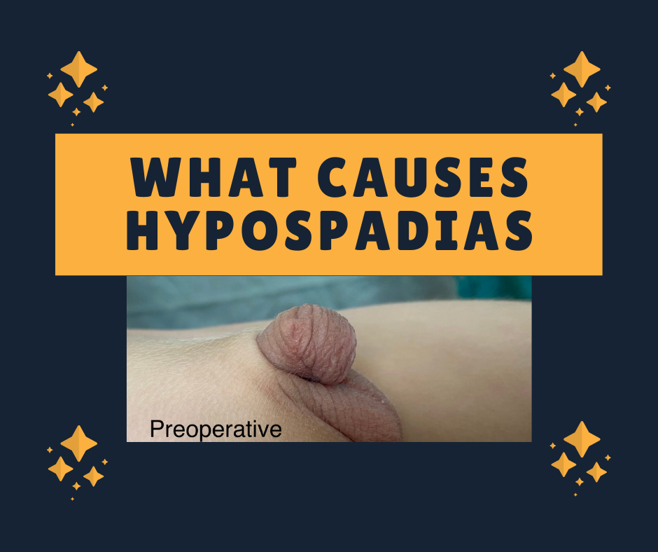 What causes hypospadias