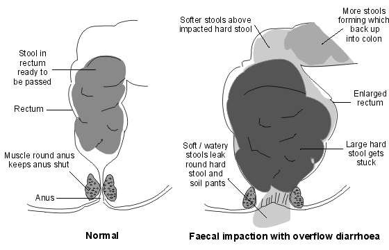 How long to on sale clear faecal impaction