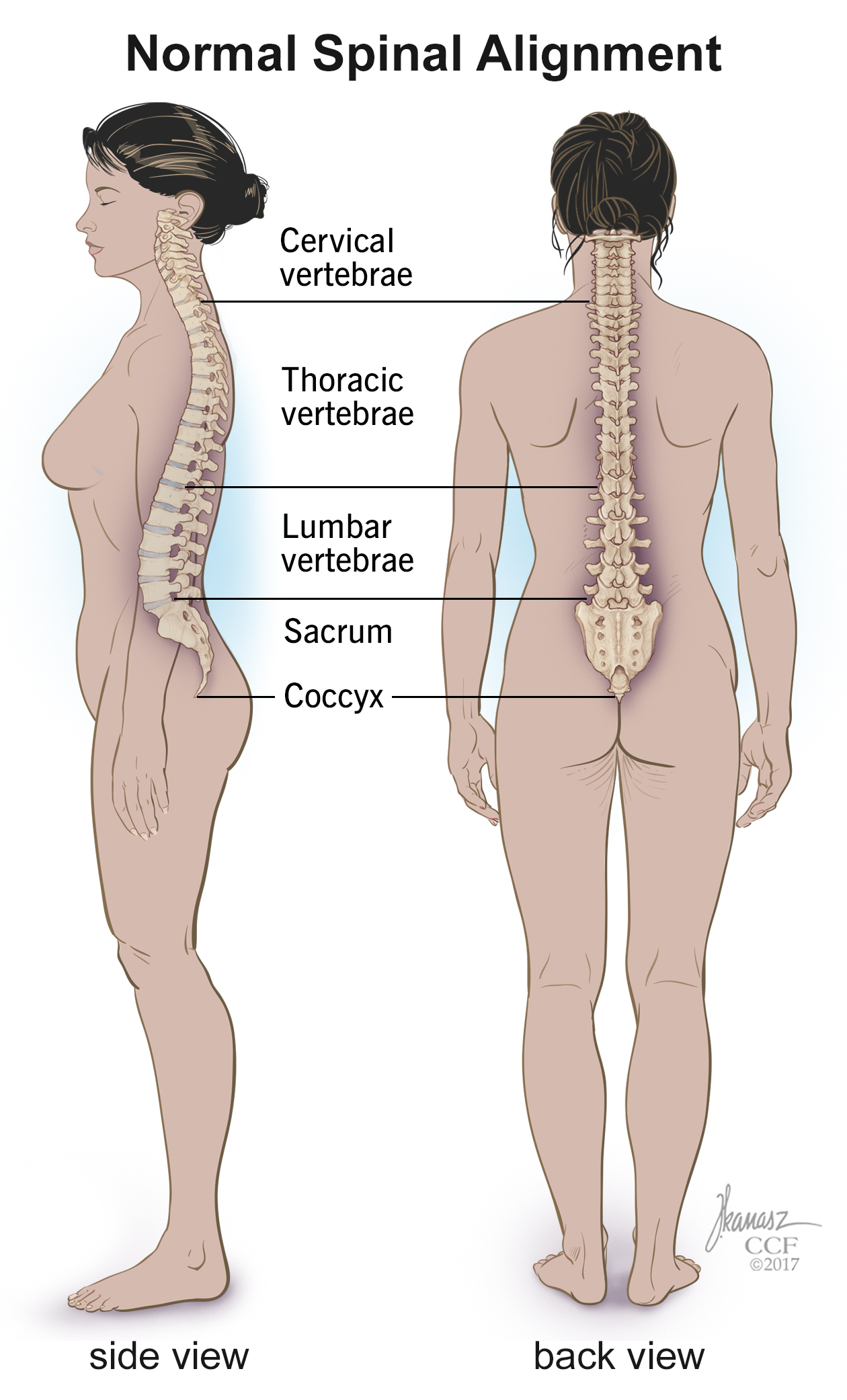 Sacral dimple