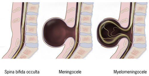 sacral dimple